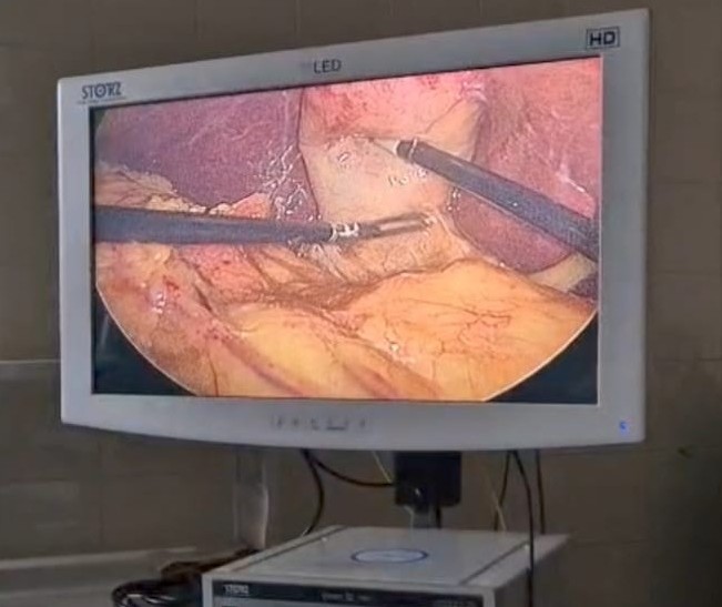 Colecistectomía Laparoscópica